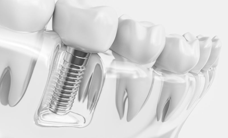 Implantes dentales especiales