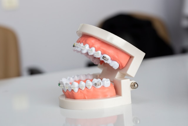 Brackets invisibles vs. tradicionales: ¿Cuál es la mejor opción para ti?
