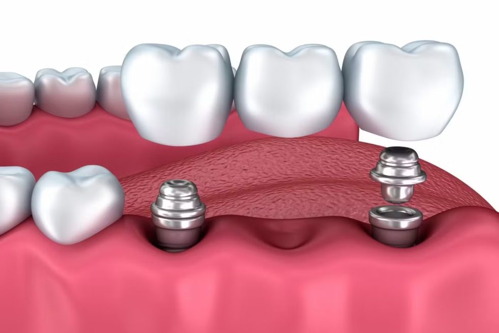 Implantes dentales