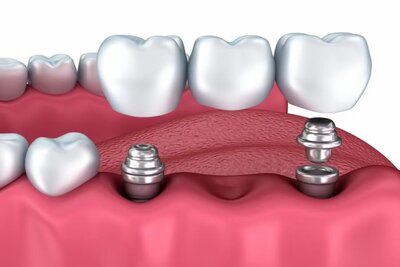 Implantes dentales