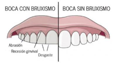 ¿Qué es el bruxismo?