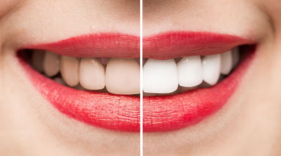 ¿Cuánto cuesta un blanqueamiento dental en Ecuador?